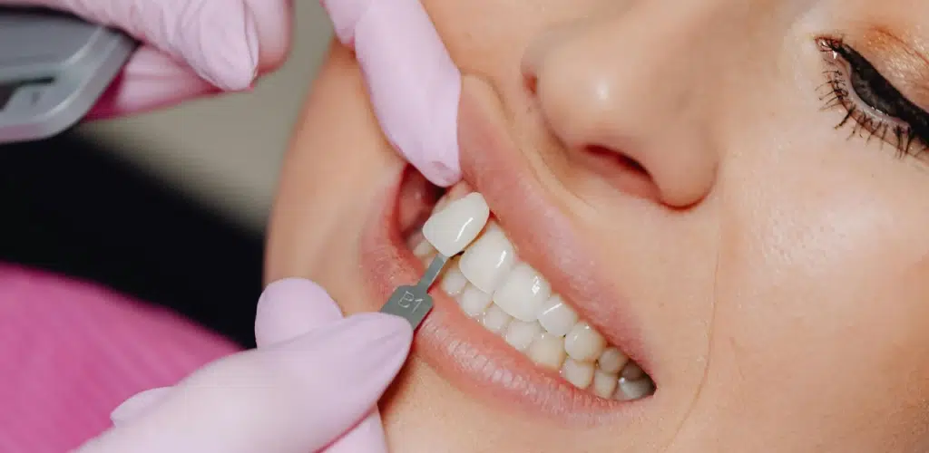 Techniques to Help Patients Achieve a Brighter Smile